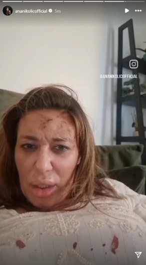 "TO JE BIO POKUŠAJ UBISTVA" Ana Nikolić otkrila sve o stravičnim ranama na licu, priča ledi krv u žilama!