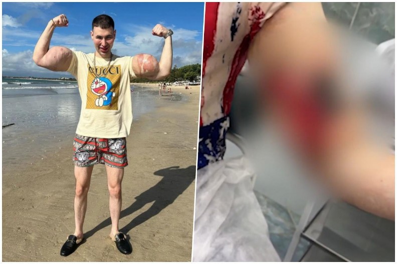 (UZNEMIRUJUĆE) POZNATOM INFLUENSERU PRETI AMPUTACIJA RUKU! Godinama ubrizgavao OPASNE supstance u bicepse kako bi izgledao SNAŽNO!