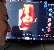 NESVAKIDAŠNJA SCENA NA ULTRAZVUKU Otac progovorio, a reakcija njegove ćerke u stomaku šokirala sve! (VIDEO)