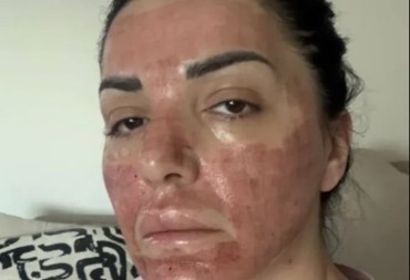 NAŠA PEVAČICA POKAZALA RANE: "Na nekoliko mesta se javilo krvarenje, izgleda užasno i bolno"