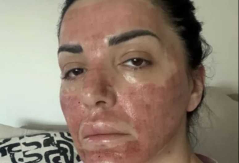 NAŠA PEVAČICA POKAZALA RANE: "Na nekoliko mesta se javilo krvarenje, izgleda užasno i bolno"