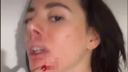 Bivšu zadrugarku pretukao dečko! Objavila jezive fotografije: Sva u podlivima, oko zatvoreno od udarca