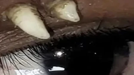 Zub mu rastao u oku! Lekari pregledali dečaka (16), a onda otkrili nešto što viđaju jednom u milion slučajeva