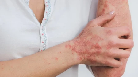 Psorijaza nije samo problem kože - kod 30 odsto obolelih razvija se i artritis