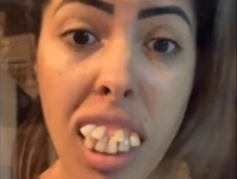 TVRDILA DA IMA NAJRUŽNIJE ZUBE, PA SE UDALA ZA ZUBARA Ljudi u NEVERICI gledaju transformaciju – a istina je ŠOKANTNA!