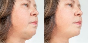 Nije do bureka: Šok istina o podbratku - pojavljuje se i mršavima, a evo šta ga pravi