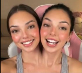 PREZGODNE SIJAMSKE BLIZNAKINJE ZAPALILE MREŽE Iza priče krije se jeziva manipulacija