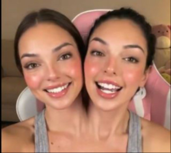 PREZGODNE SIJAMSKE BLIZNAKINJE ZAPALILE MREŽE Iza priče krije se jeziva manipulacija