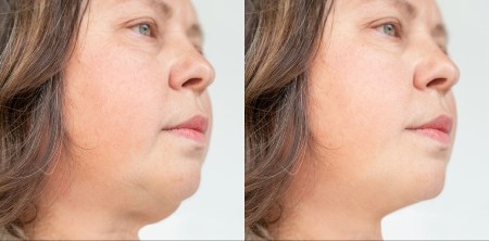 Nije do bureka: Šok istina o podbratku - pojavljuje se i mršavima, a evo šta ga pravi