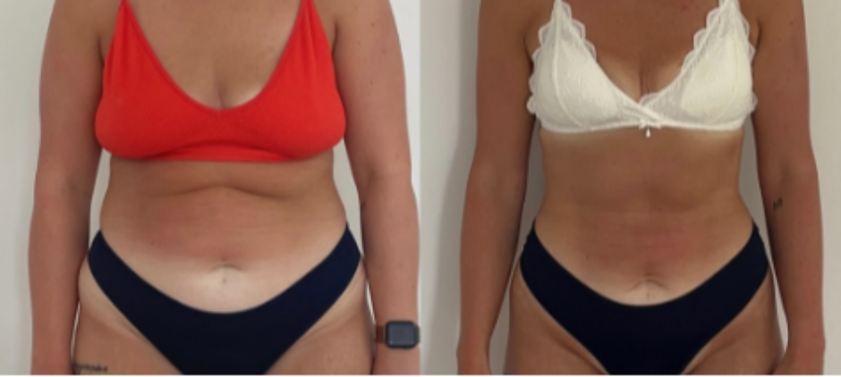 MNOGI SRBI ZANEMARUJU OVU NAVIKU Zbog nje devojka za 8 meseci smršala 24 kilograma (FOTO)