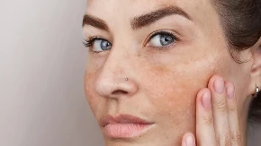 Ne bacajte pare na kreme, nego samo ovo: Prirodni sastojak koji briše staračke pege sa lica, trebaju vam samo 2 namirnice