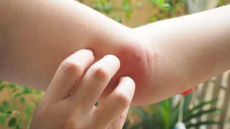 Evo kako da prepoznate koji insekt vas je ujeo: Ako primetite ovo, odmah kod lekara!