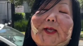 TRAŽILA LEPOTU, DOBILA NOĆNU MORU Estetski zahvat pošao po zlu – lice POTPUNO DEFORMISANO!