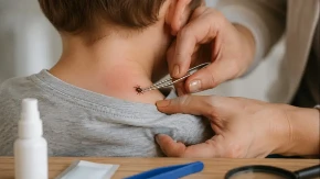 „Dete od 3 godine imalo je krpelja, skinula sam ga sapunom“ Ovoj mami odmah je stigao savet medicinske sestre