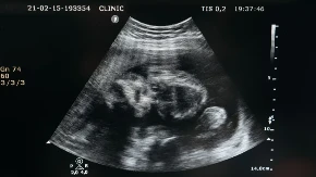 Placenta u trudnoći: Najvažniji organ koji hrani, štiti i oblikuje razvoj vaše bebe