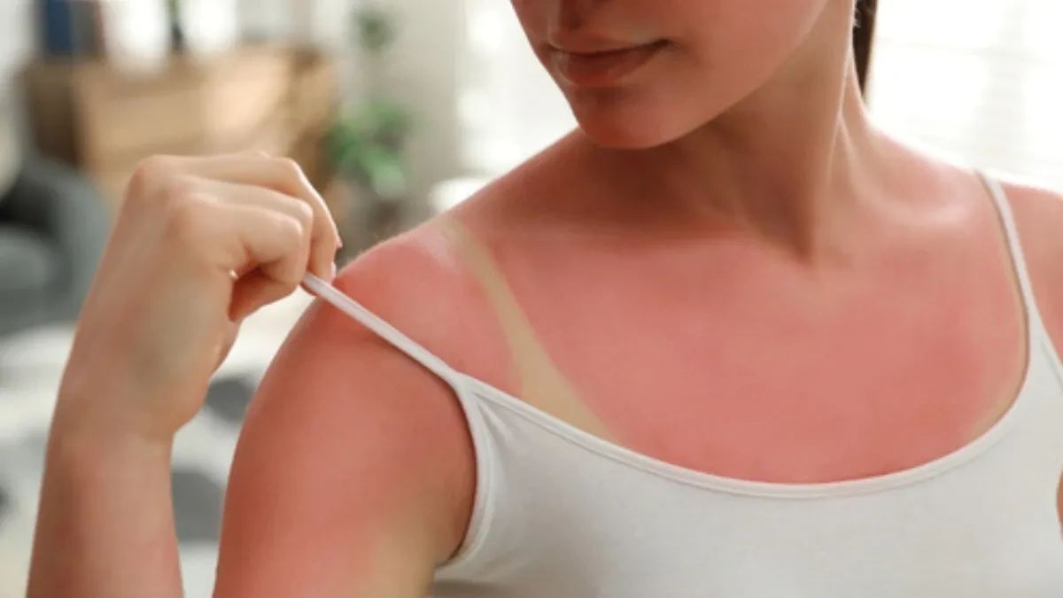 Izgoreli ste na suncu? Većina Srba pravi ovu grešku nakon sunčanja, a evo šta jedino spasava sprženu kožu