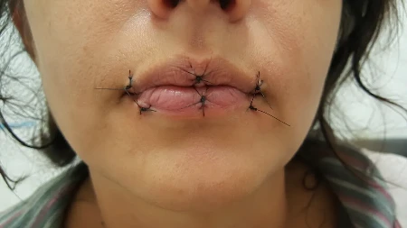 Jeziv slučaj ledi krv u žilama: Žena cimerki zašila usne, ona pomoć tražila porukom na papiru (Video)