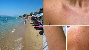 Šok po povratku iz Grčke! Srbi se osuli od glave do pete, evo šta bi mogao da bude uzrok