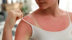 Opekotine od sunca ublažim ovim melemom: Crvenilo i peckanje nestanu do jutra!