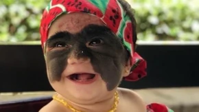 Sećate se Lune koja je rođena sa „Betmen maskom“ na licu? Vređali su je, rekli da je čudovište, a ovako izgleda danas posle silnih operacija!
