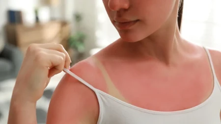 Koža mi se spržila na suncu: Namažem ovu mešavinu i opekotine nestanu do jutra!